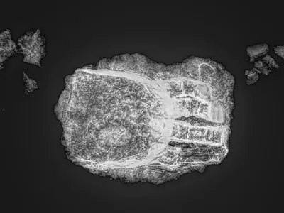 An X-ray shows where the prosthetic metal fingers attach to the device.