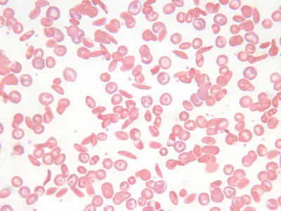 A blood smear of a patient with sickle cell. The crescent-shaped sickle cells can be seen in the smear.