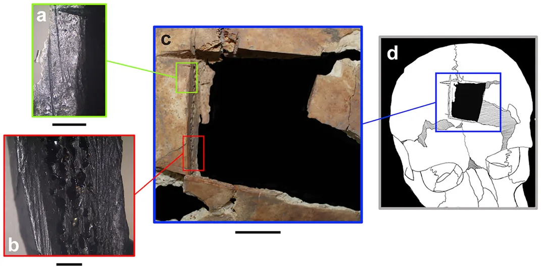 Graphic of Trepanation